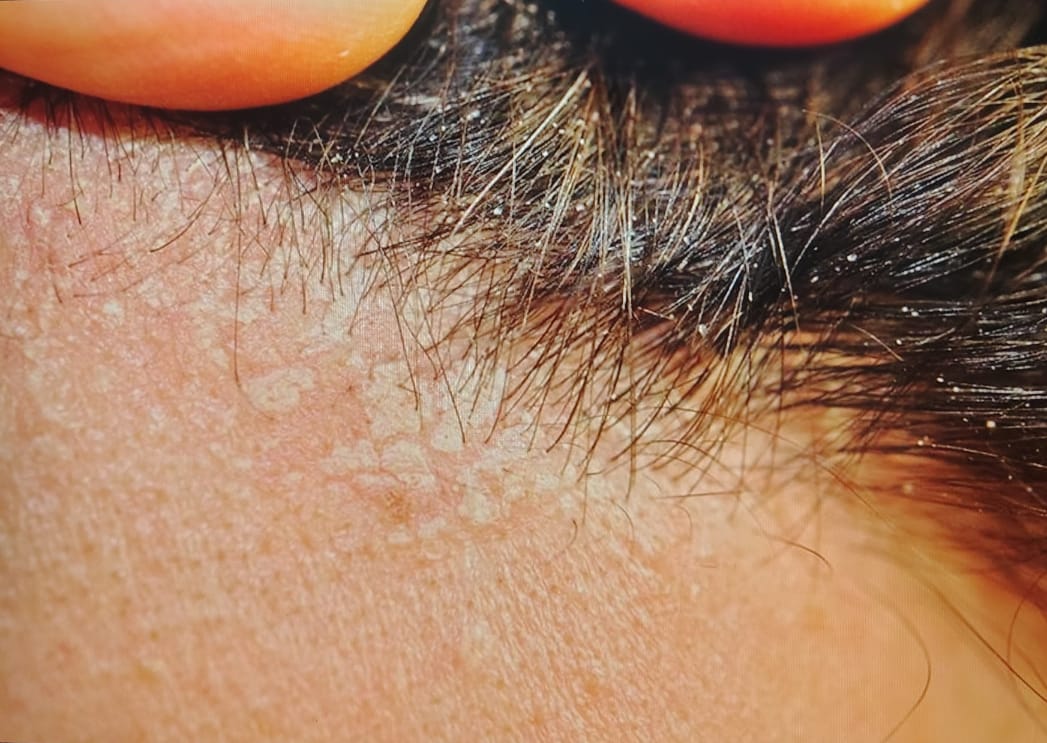 SHANPOO DERMATOLOGICO 5 en 1 ANXIOR – MAS MASAJEADOR DE CUERO CABELLUDO