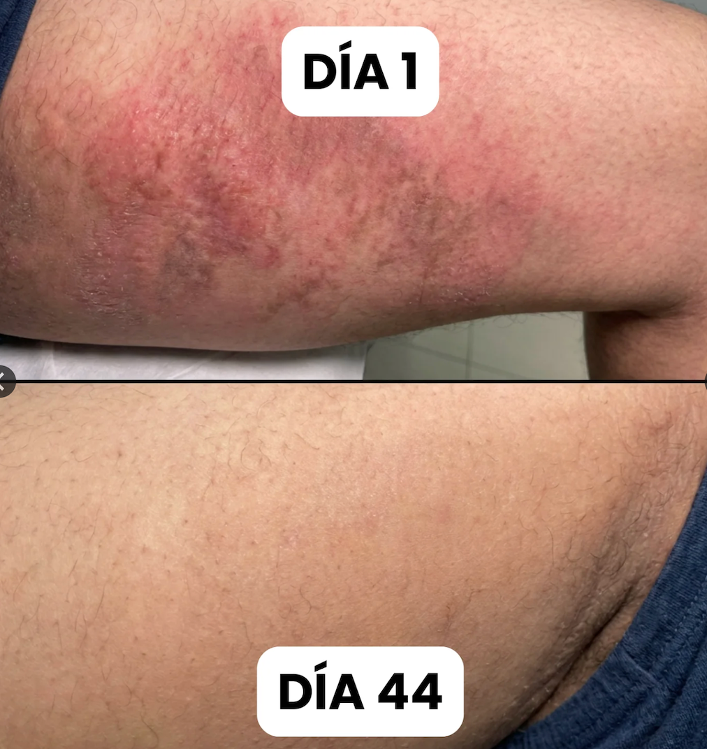 Dermafung Forte - Crema de Cuidado de los Pliegues de la Piel.