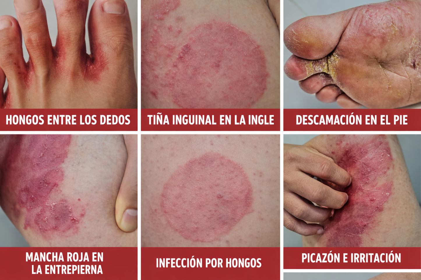 Crema Antifúngica  para Tiña y hongos en la Piel – Dermafung Forte