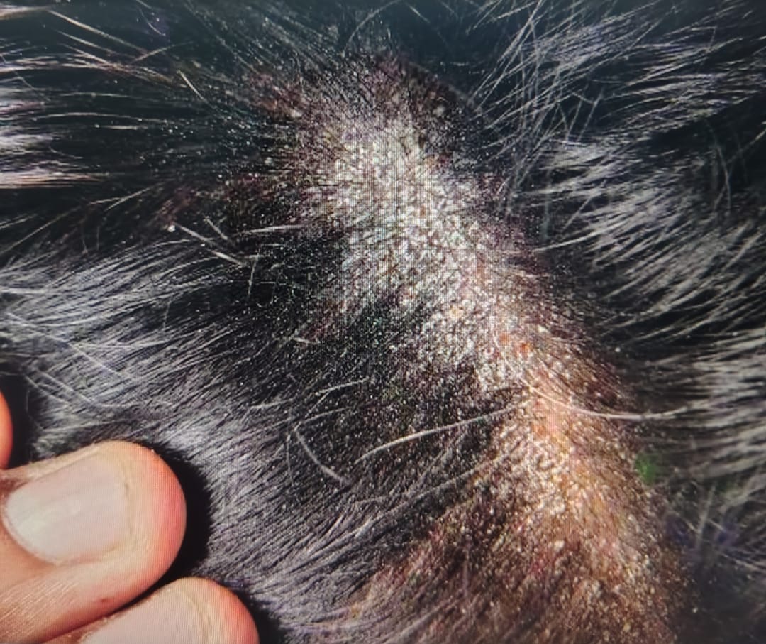 SHANPOO DERMATOLOGICO 5 en 1 ANXIOR – MAS MASAJEADOR DE CUERO CABELLUDO