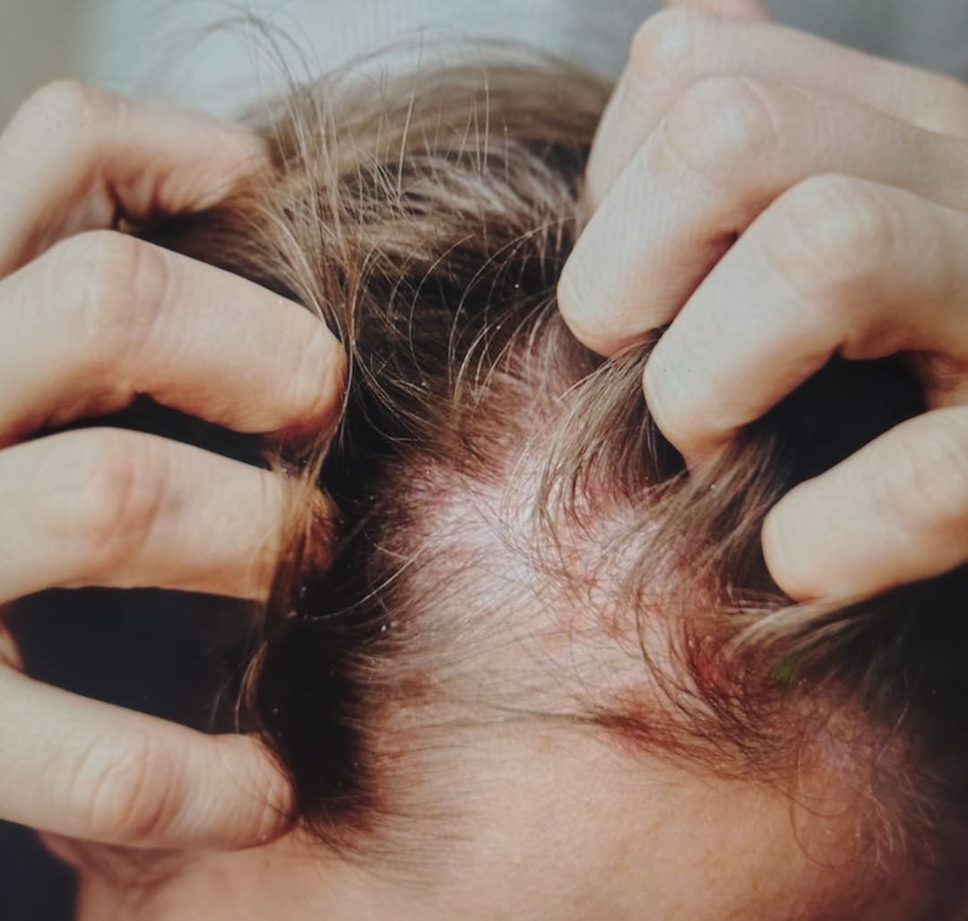 SHANPOO DERMATOLOGICO 5 en 1 ANXIOR – MAS MASAJEADOR DE CUERO CABELLUDO