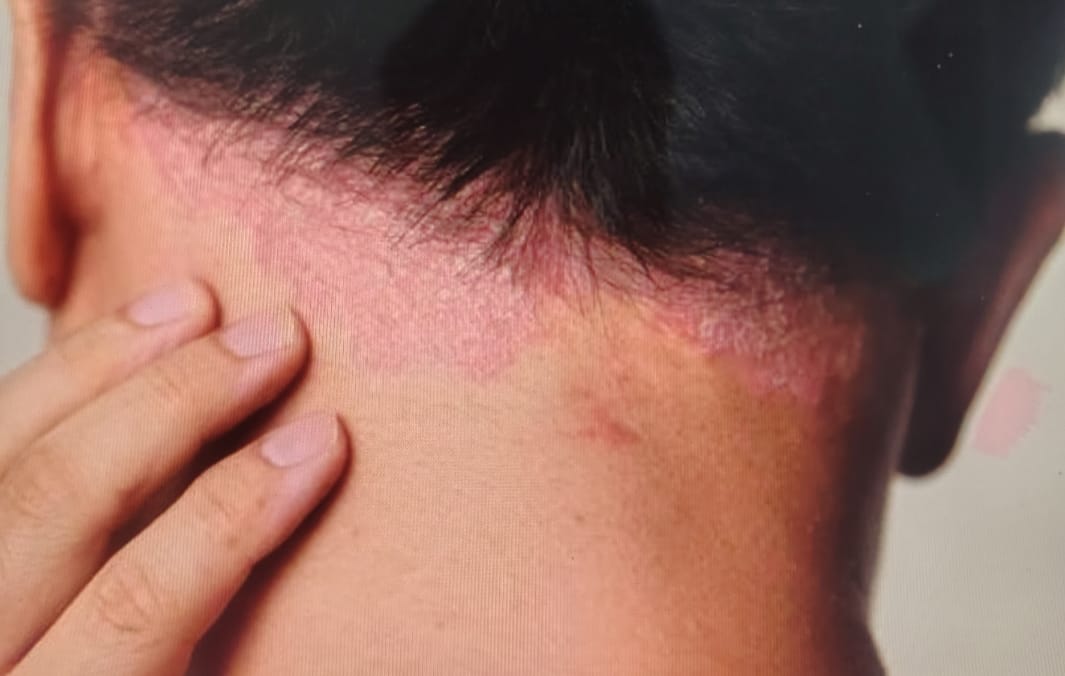 Crema Antifúngica  para Tiña y hongos en la Piel – Dermafung Forte